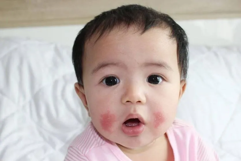 Trẻ bị dị ứng sữa triệu chứng như thế nào?