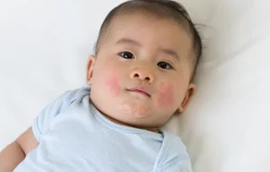 Trẻ bị dị ứng thức ăn ba mẹ phải làm sao?