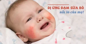 Trẻ bị dị ứng đạm sữa bò, những điều ba mẹ cần biết